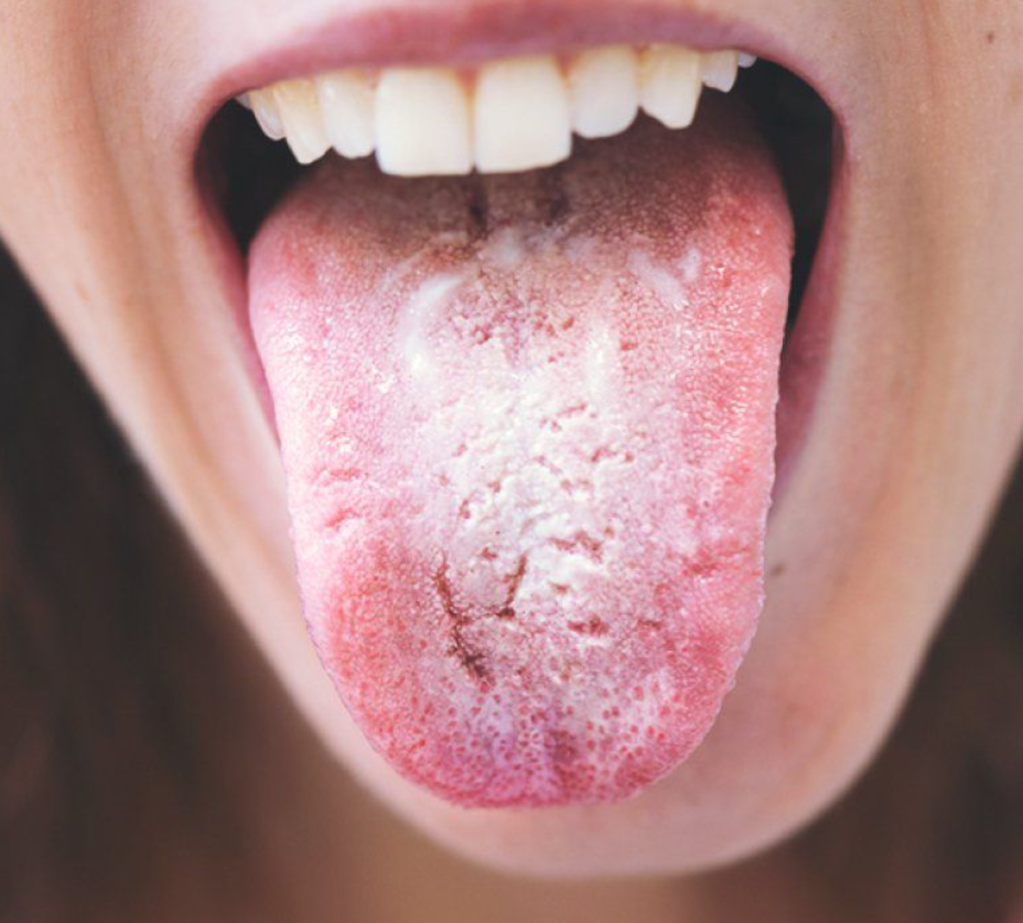 Candida Overgrowth: Signs, Causes, and How to Address It